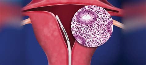 Endometrial biopsy: 5 things to expect .